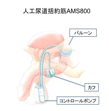 図:人工尿道括約筋AMS800