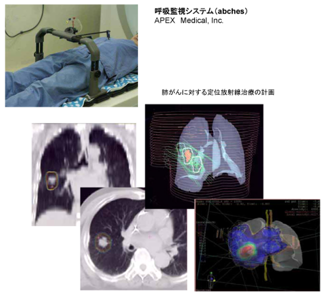 ti_0907_2hou.jpg 呼吸監視システム・肺がんに対する定位放射線治療の計画