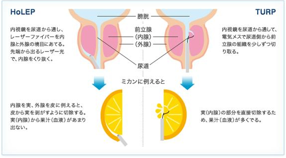 ti_0901_2zen2.jpg 図2.ホルミウム・ヤグレーザー前立腺核出術(HoLEP)と経尿道的前立腺切除術(TUR-P)の比較説明