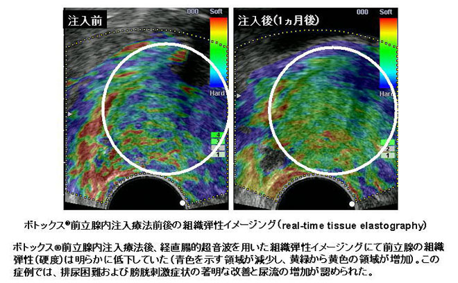 ti_0612zenritu.jpg ボトックス前立腺内注入療法前後の組織弾性イメージング