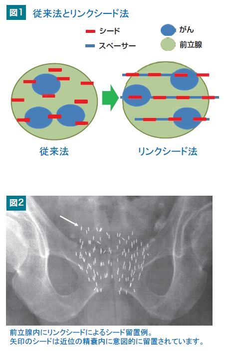 HP_前立腺がんに対する密封小線源治療.jpg HP_前立腺がんに対する密封小線源治療.jpg