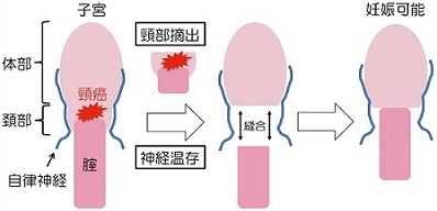 図1子宮頸癌妊孕性温存手術